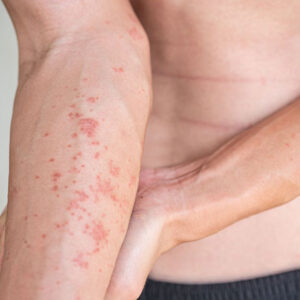 Atopic Dermatitis