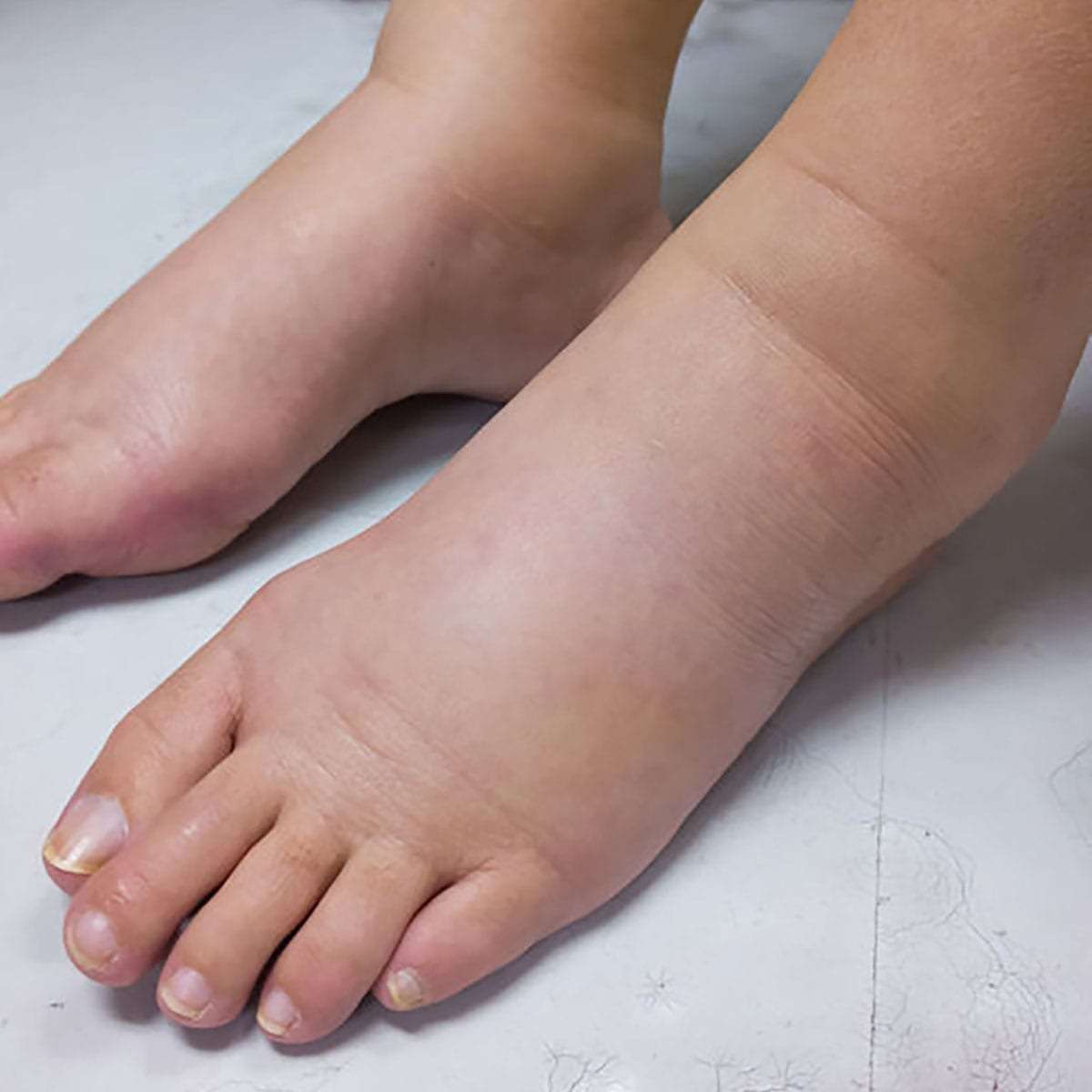 Juvenile Idiopathic Arthritis